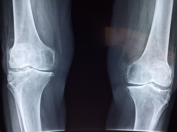 The Signs & Symptoms of Weak Bones